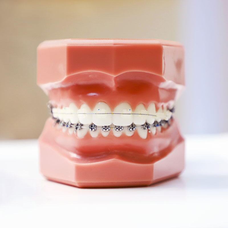 What Takes Longer: Clear Aligners or Braces? - Orange Coast